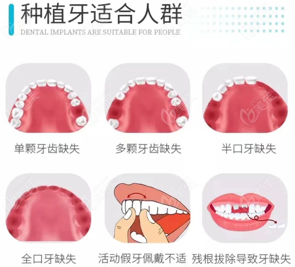 告知北京荷马口腔种植牙价格是多少钱