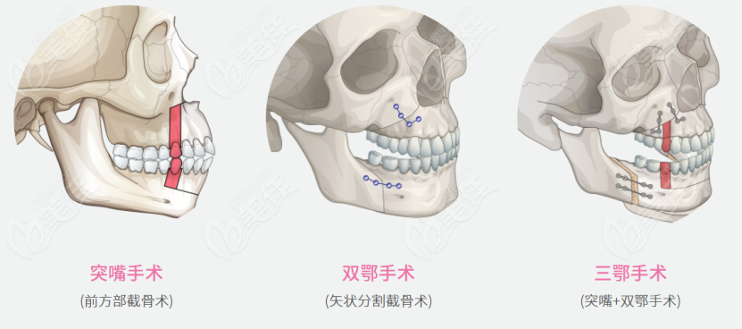 這一份韓國(guó)凸嘴手術(shù)醫(yī)院排名約等于是韓國(guó)正頜手術(shù)醫(yī)院排名哦