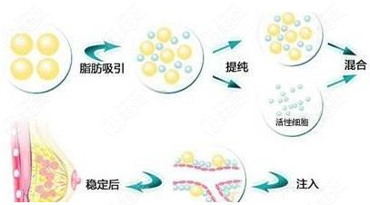 在郴州维纳斯做自体脂肪填充丰胸还不错