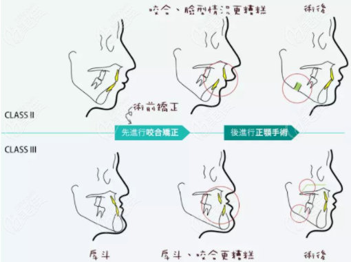 微创正颌手术是什么呢