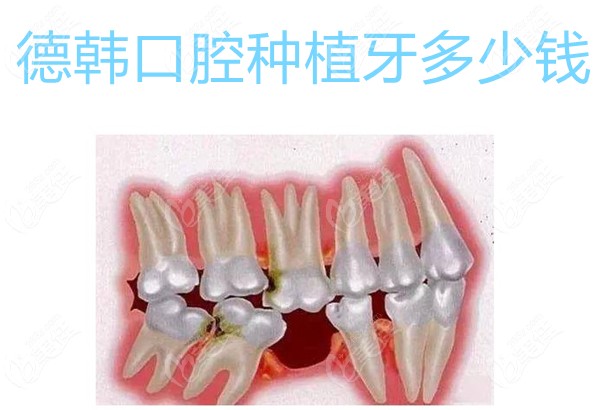 德韓口腔種植牙多少錢