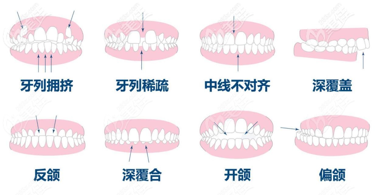 一键知晓隐适美极速版、时代天使简单版or隐秀哪个矫正器更好