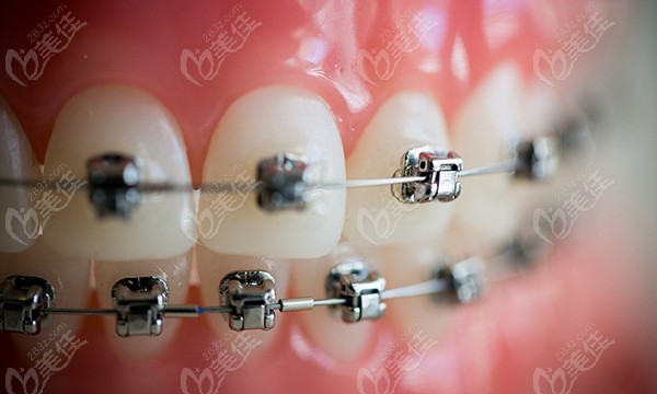 泰安牙齿矫正医院排名上能看出牙齿地包天要在泰安哪里矫正吗