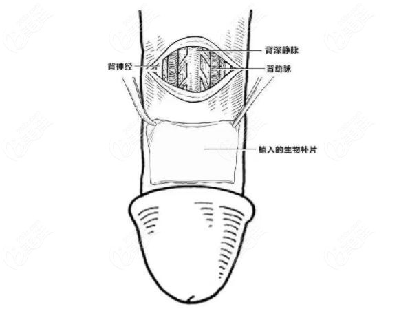 生物補(bǔ)片是什么