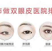 在宿州割雙眼皮哪家好呢