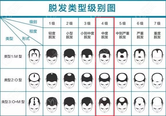 上海秃顶植发价位公示啦