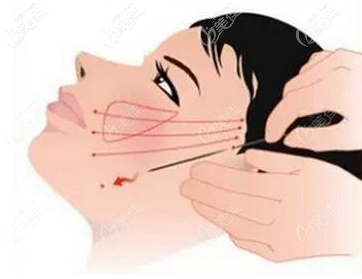 面部韧带组织松弛导致下垂做埋线提升面部要几根线