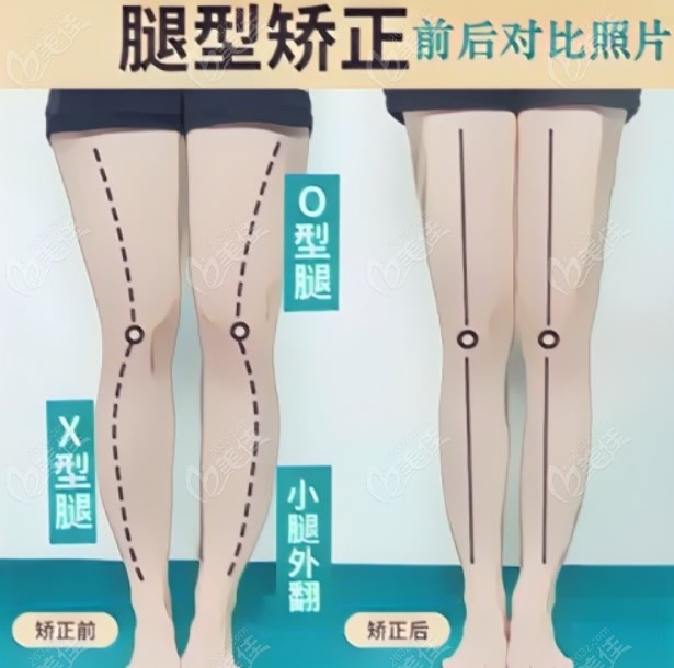 上海o型腿矫正哪家医院好