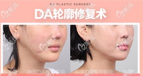 从韩国DA的下颌角凹陷失败修复案例就能看出