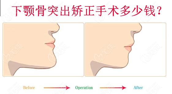 下顎骨突出矯正手術(shù)需要多少錢