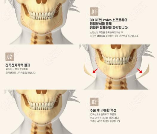 韩国1%整形外科做下颌角手术怎么样