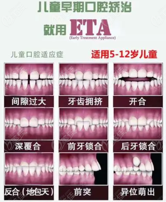 兒童早期牙齒干預矯正器有