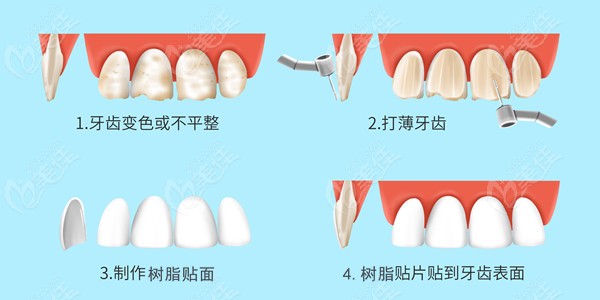 除了知道納米樹(shù)脂貼面多少錢/顆