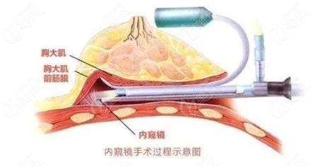 成都胸部奧美定取出哪個醫(yī)生做得好