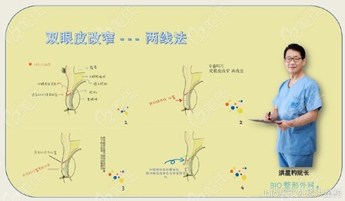 提肌過高后出現(xiàn)瞪眼找韓國BIO的洪星杓院長做雙眼皮退肌修復(fù)怎么樣