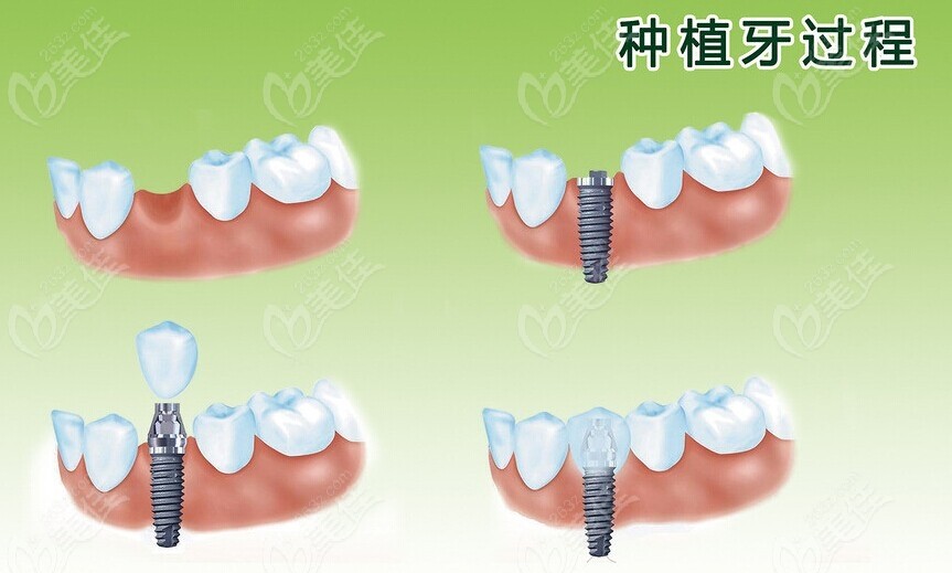 湖北恩施全口牙種植牙多少錢