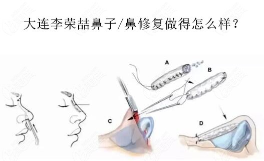 大连李荣喆鼻子/鼻修复做得怎么样