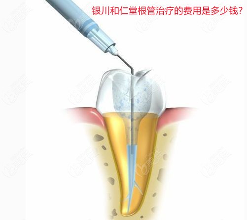 透露银川和仁堂根管治疗的费用是多少钱