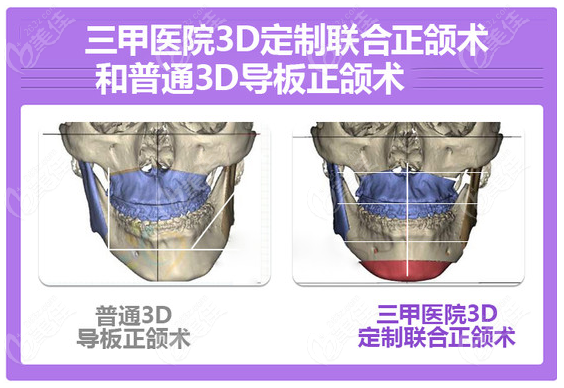 广州医科大朴正国正颌做的特别好哦