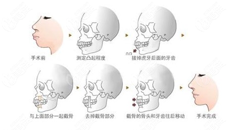 正颌手术复发和反弹怎么区别