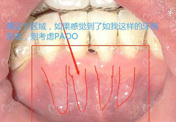 PAOO可以预防牙槽骨吸收吗