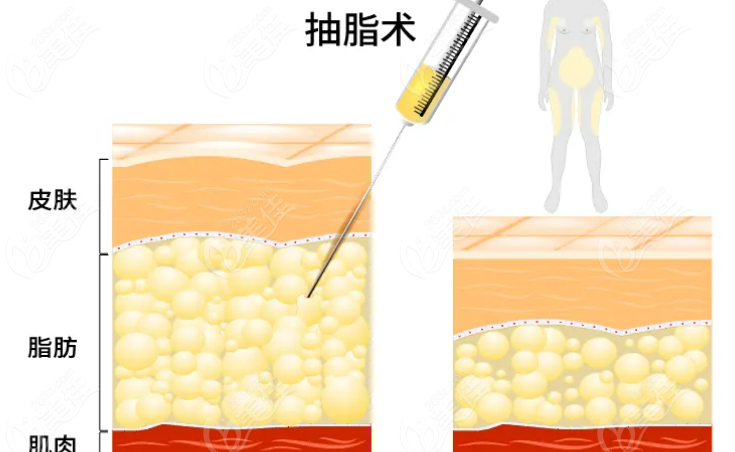 西安吸脂好的醫(yī)生排名公布