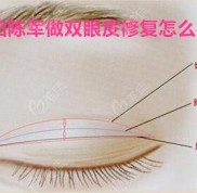 沈陽陳軍做雙眼皮修復(fù)怎么樣