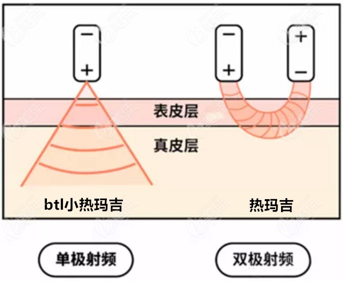 48歲眼部除皺做小熱瑪吉btl和熱瑪吉有什么不同