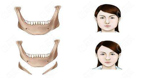 下颌角低好还是高好呢