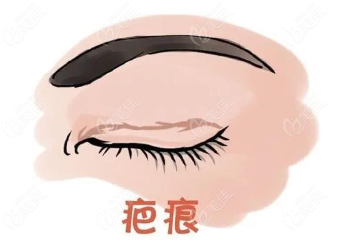 郑州做双眼皮修复多少钱