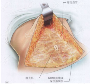 腹壁成型術(shù)后要多躺嗎