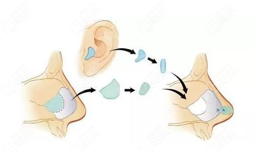 鼻綜合修復(fù)耳軟骨可以二次使用嗎