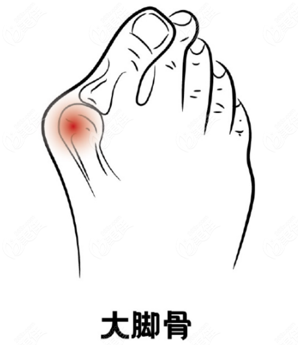 5D微孔弧去大腳骨怎么樣