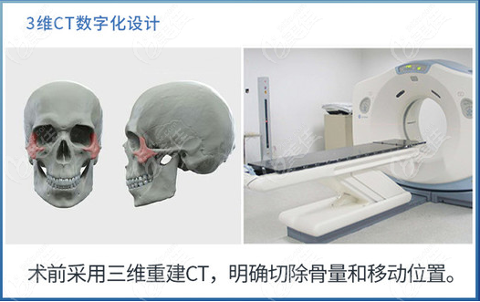 重庆北部宽仁医院做颧骨手术挺厉害的