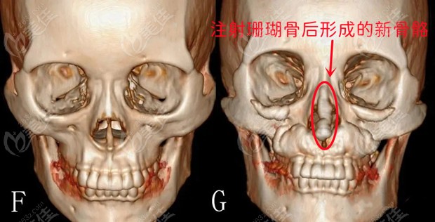 葡聚糖隆鼻和珊瑚骨隆鼻的區(qū)別里