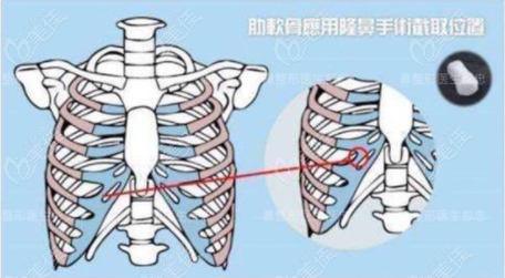 做肋骨鼻综合手术一般需要多少钱