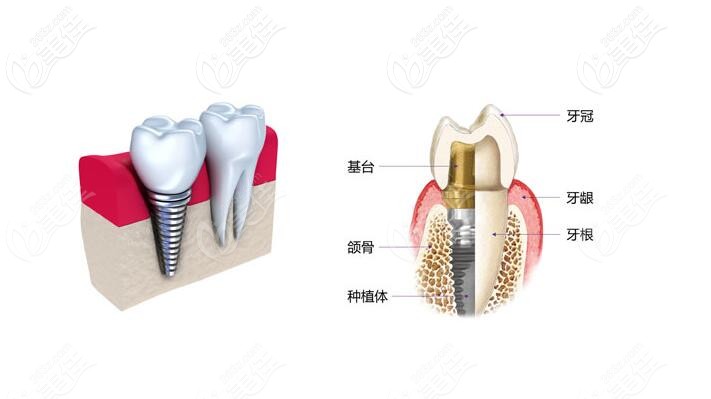 門牙為什么要即拔即種