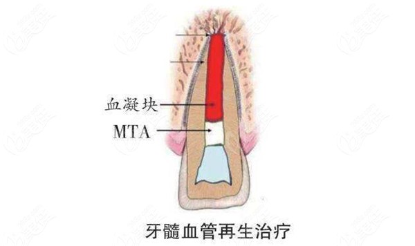 解析牙髓血管再生术的步骤、适应症、费用以及成功率