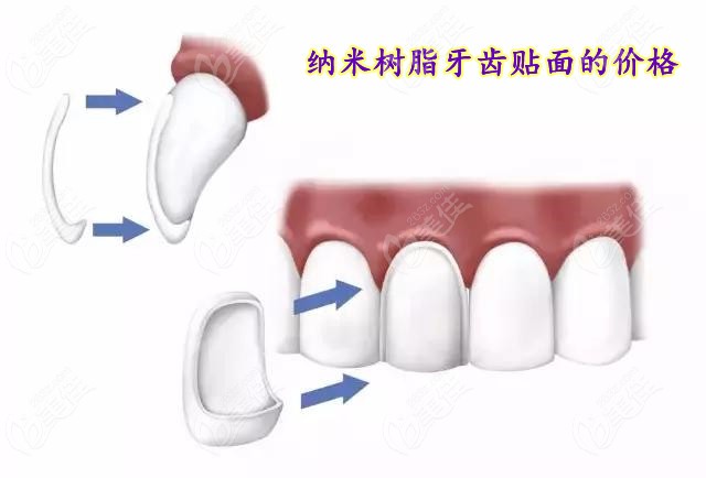 除了知道納米樹(shù)脂貼面多少錢/顆