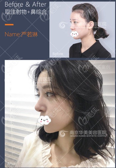 南京曹海峰做鼻失敗修復(fù)怎么樣