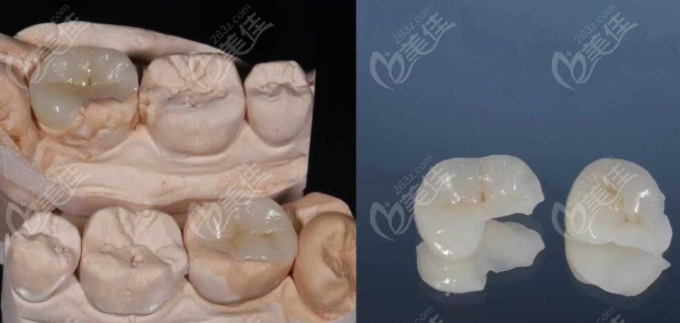 嵌体为什么比牙冠贵、牙齿做嵌体和牙冠的区别是
