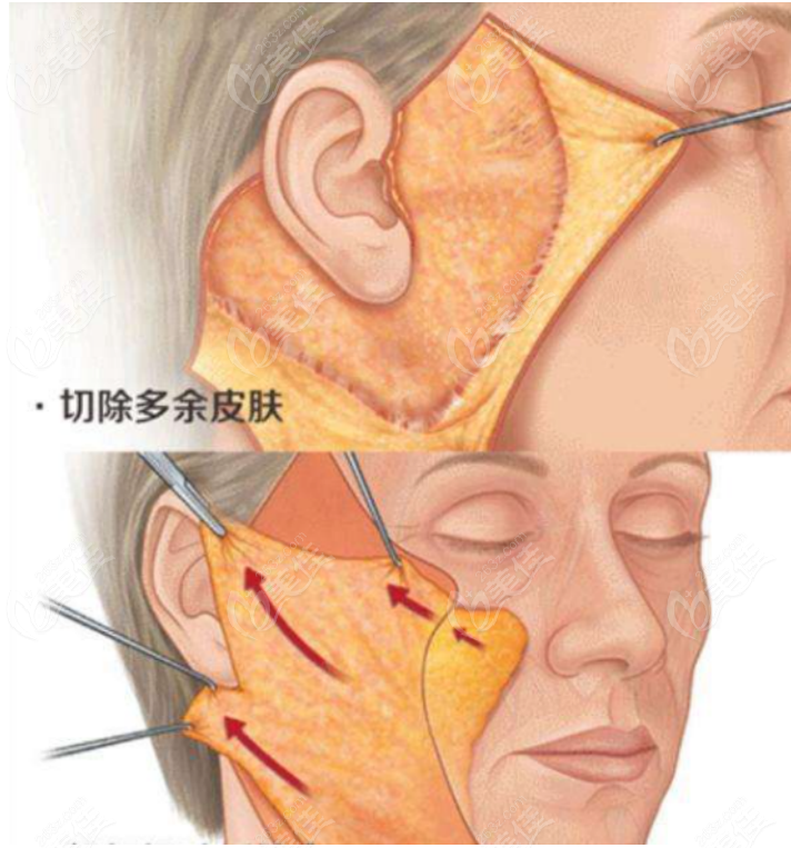 八爪魚(yú)面部提升術(shù)多少錢