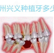 貴州興義種植牙多少錢