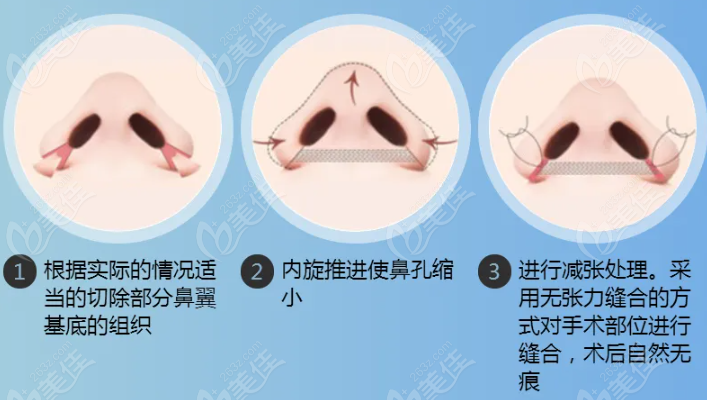 从鼻翼缩小手术内切和外切的区别来了解该怎么选择