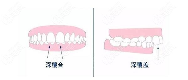 成人天包地矯正后臉型變化圖來(lái)看做正頜手術(shù)臉會(huì)不會(huì)變長(zhǎng)