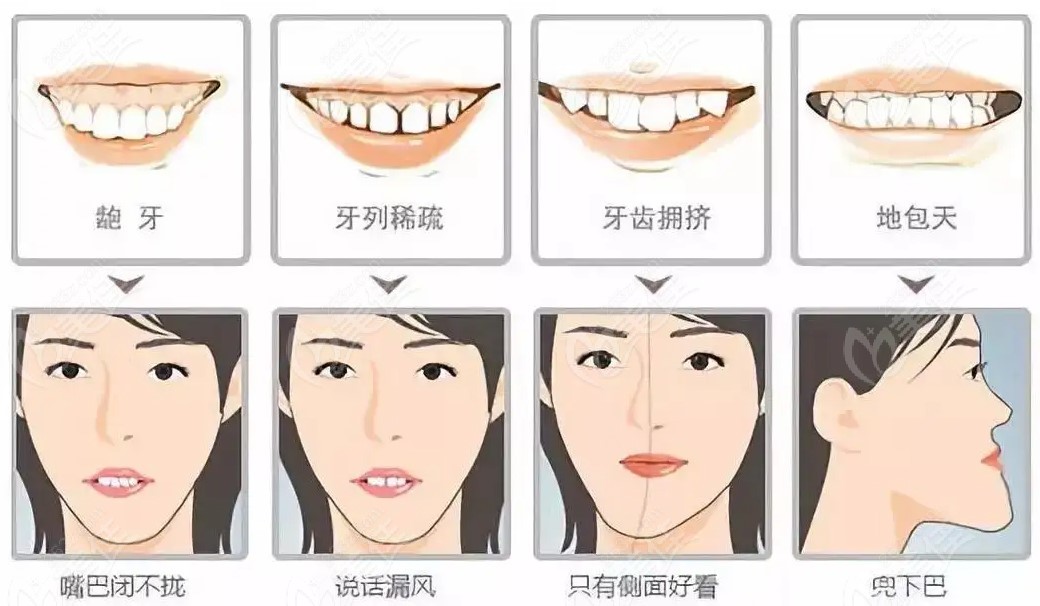 在慈溪矯正牙齒得多少錢