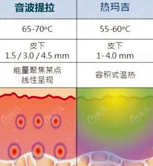 音波提拉和熱瑪吉的區(qū)別是啥