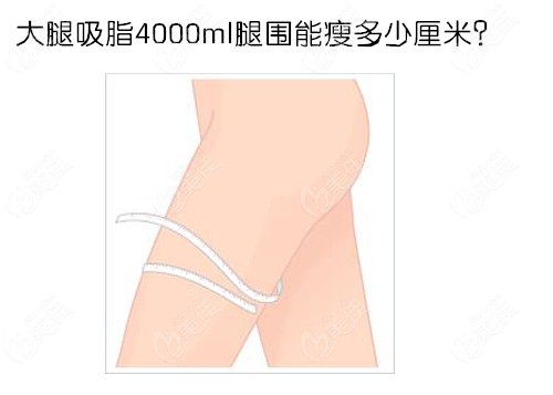 大腿吸脂4000ml腿圍能瘦多少厘米