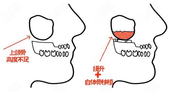 种植牙为什么要做上颌窦提升