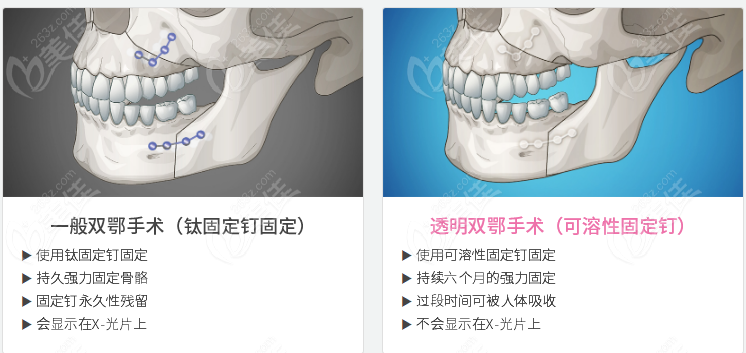 韓國(guó)做雙鄂手術(shù)好的醫(yī)生來(lái)啦